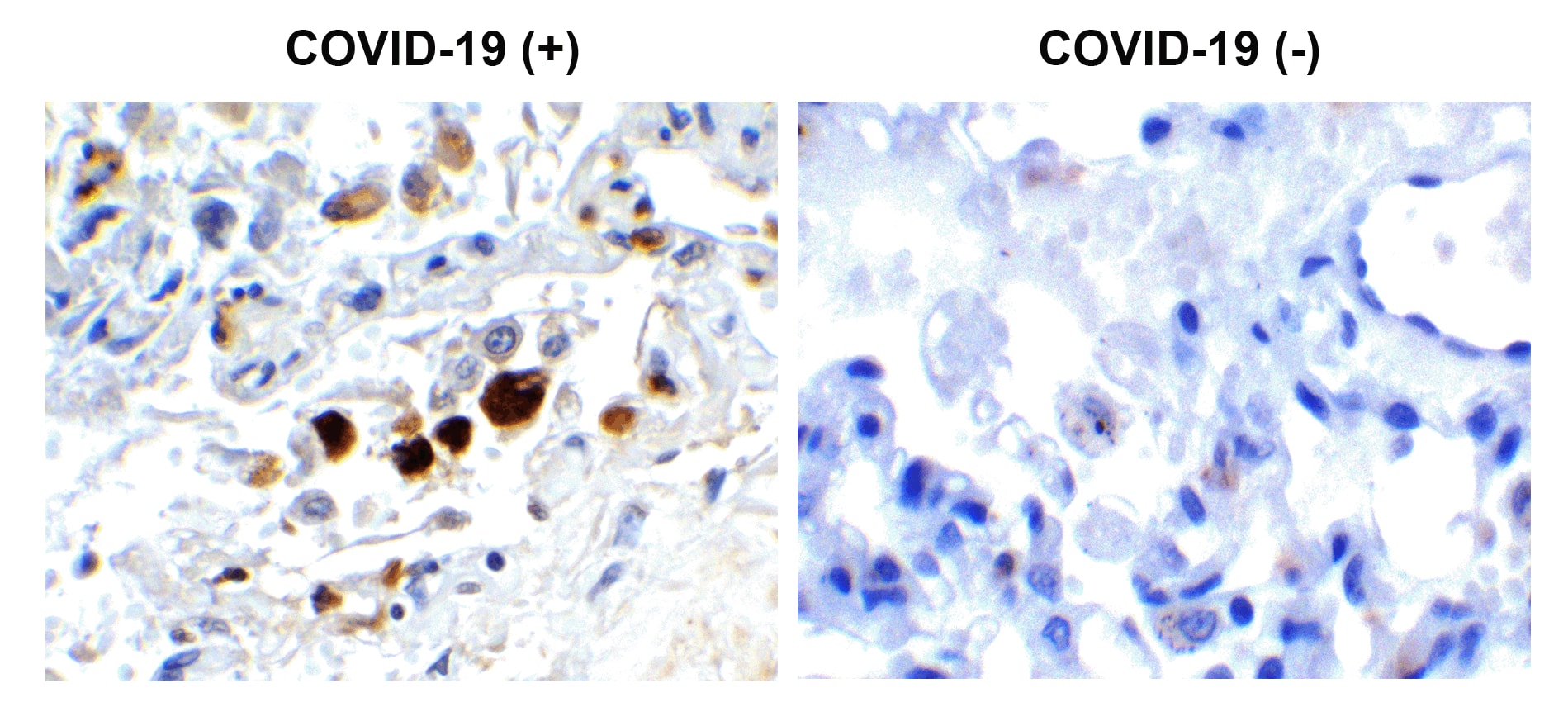 Immunohistochemistry: SARS-CoV-2 Membrane Protein Antibody - BSA Free [NBP3-07058] - Figure 1 Immunohistochemistry Validation of SARS-CoV-2 (COVID-19) Membrane in COVID-19 Patient Lung Immunohistochemical analysis of paraffin-embedded COVID-19 patient lung tissue using anti- SARS-CoV-2 (COVID-19) Membrane antibody (, 0.5 u/mL). Tissue was fixed with formaldehyde and blocked with 10% serum for 1 h at RT; antigen retrieval was by heat mediation with a citrate buffer (pH6). Samples were incubated with primary antibody overnight at 4C. A goat anti-rabbit IgG H&L (HRP) at 1/250 was used as secondary. Counter stained with Hematoxylin. Strong signal of SARS-COV-2 Membrane protein was observed in macrophage of COVID-19 patient lung, but not in non-COVID-19 patient lung.