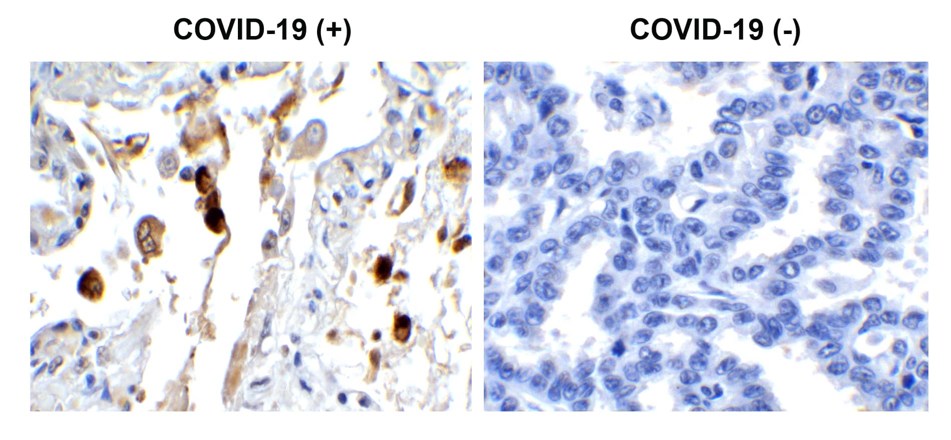 Immunohistochemistry: SARS-CoV-2 Membrane Protein Antibody - BSA Free [NBP3-07059] - Figure 1 Immunohistochemistry Validation of SARS-CoV-2 (COVID-19) Membrane in COVID-19 Patient Lung Immunohistochemical analysis of paraffin-embedded COVID-19 patient lung tissue using anti- SARS-CoV-2 (COVID-19) Membrane antibody (, 0.5 u/mL). Tissue was fixed with formaldehyde and blocked with 10% serum for 1 h at RT; antigen retrieval was by heat mediation with a citrate buffer (pH6). Samples were incubated with primary antibody overnight at 4C. A goat anti-rabbit IgG H&L (HRP) at 1/250 was used as secondary. Counter stained with Hematoxylin. Strong signal of SARS-COV-2 Membrane protein was observed in macrophage of COVID-19 patient lung, but not in non-COVID-19 patient lung.