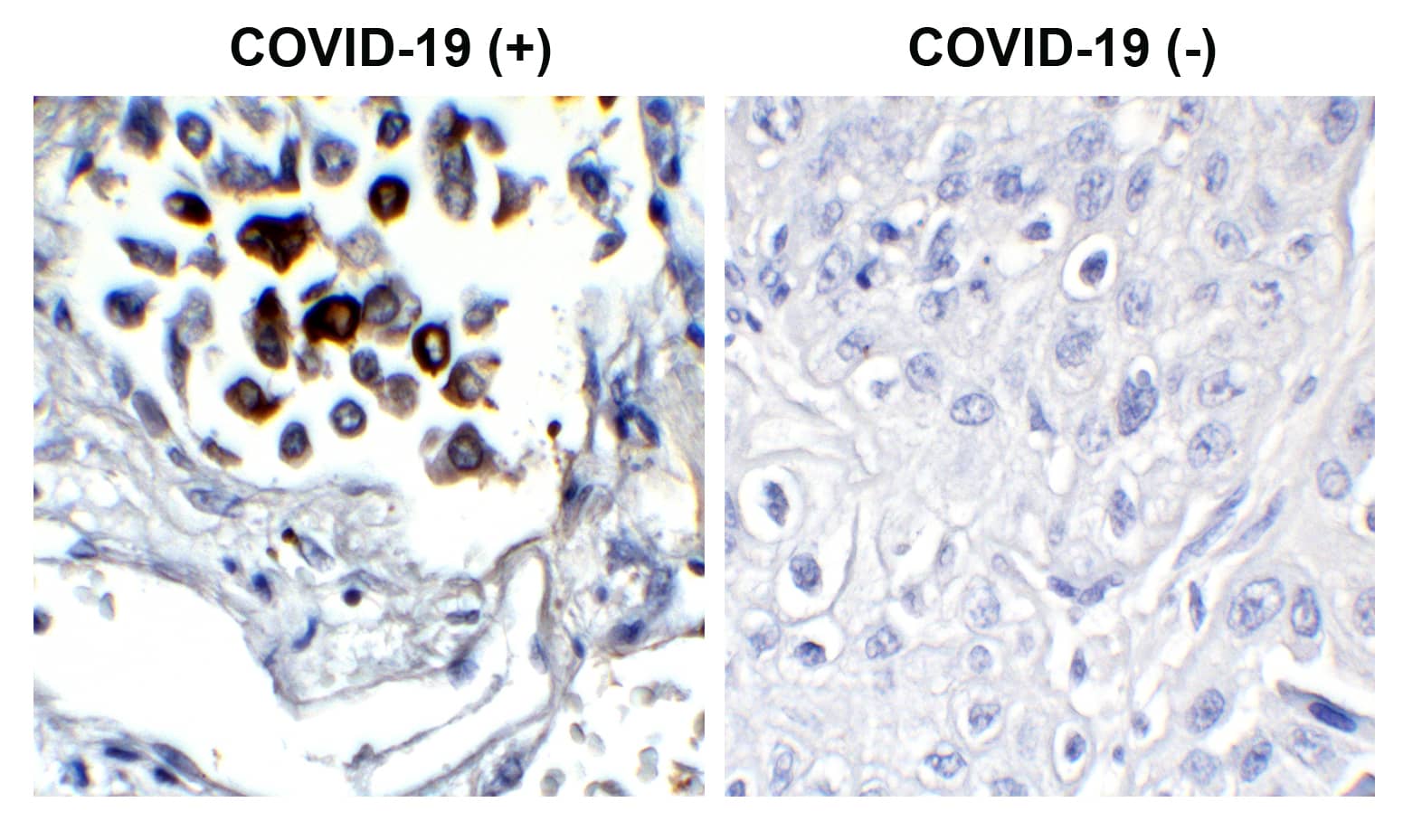 Immunohistochemistry: SARS-CoV-2 Nucleocapsid Antibody (3865) - BSA Free [NBP3-07068] - Validation of SARS-CoV-2 (COVID-19) Nucleocapsid  in COVID-19 Patient Lung.  Immunohistochemical analysis of paraffin-embedded COVID-19 patient lung tissue using anti- SARS-CoV-2 (COVID-19) Nucleocapsid  antibody (1 ug/mL). Tissue was fixed with formaldehyde and blocked with 10% serum for 1 h at RT; antigen retrieval was by heat mediation with a citrate buffer (pH6). Samples were incubated with primary antibody overnight at 4C. A goat anti-rabbit IgG H&L (HRP) at 1/250 was used as secondary. Counter stained with Hematoxylin. Strong signal of SARS-COV-2 Nucleocapsid protein was observed in the macrophages of COVID-19 patient lung, but not in non-COVID-19 patient lung