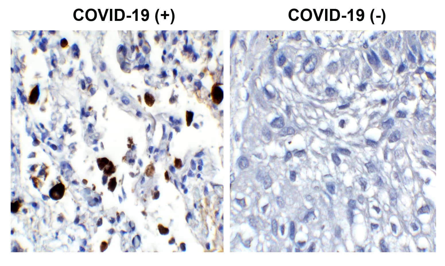 Immunohistochemistry: SARS-CoV-2 Nucleocapsid Antibody (3866) - BSA Free [NBP3-07069] - Validation of SARS-CoV-2 (COVID-19) Nucleocapsid  in COVID-19 Patient Lung. Immunohistochemical analysis of paraffin-embedded COVID-19 patient lung tissue using anti- SARS-CoV-2 (COVID-19) Nucleocapsid  antibody (1 ug/mL). Tissue was fixed with formaldehyde and blocked with 10% serum for 1 h at RT; antigen retrieval was by heat mediation with a citrate buffer (pH6). Samples were incubated with primary antibody overnight at 4C. A goat anti-rabbit IgG H&L (HRP) at 1/250 was used as secondary. Counter stained with Hematoxylin. Strong signal of SARS-COV-2 Nucleocapsid protein was observed in the macrophages of COVID-19 patient lung, but not in non-COVID-19 patient lung.