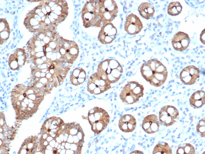 Formalin-fixed, paraffin-embedded human colon stained with Villin 1 antibody (VIL1/2310R).