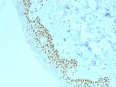 Immunohistochemistry-Paraffin: p63/TP73L Antibody (TP63/2428) [NBP3-07443] - Formalin-fixed, paraffin-embedded human basal cell carcinoma stained with p63/TP73L Mouse Monoclonal Antibody (TP63/2428).