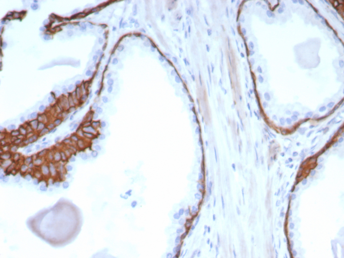 Formalin-fixed, paraffin-embedded human prostate carcinoma stained with Cytokeratin 13 antibody (KRT13/2850). HIER: Tris/EDTA, pH9.0, 45min. Secondary: HRP-polymer, 30min. DAB, 5min.