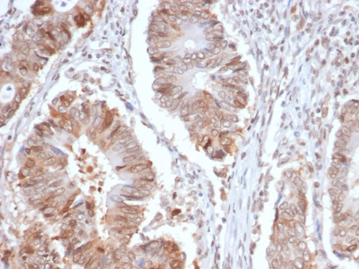 IHC analysis of formalin-fixed, paraffin-embedded human colon carcinoma. Cytoplasmic staining using RRM1 antibody (RRM1/4372R) at 2ug/ml in PBS for 30min RT. HIER: Tris/EDTA, pH9.0, 45min. Secondary: HRP-polymer, 30min. DAB, 5min.