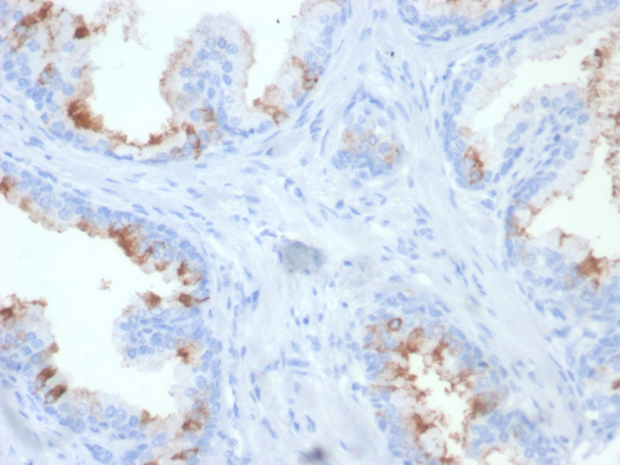 Formalin-fixed, paraffin-embedded human prostate carcinoma stained with PSMA/FOLH1/NAALADase I antibody (FOLH1/2354) at 2ug/ml. HIER: Tris/EDTA, pH9.0, 45min. Secondary: HRP-polymer, 30min. DAB, 5min.