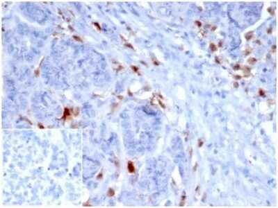 Immunohistochemistry-Paraffin: SREBP1 Antibody (SREBP1/1578) - Azide and BSA Free [NBP3-08432] - IHC analysis of formalin-fixed, paraffin-embedded human ovarian carcinoma. SREBP1 antibody (SREBP1/1578) at 2ug/ml. Inset: PBS instead of primary antibody; secondary only negative control.
