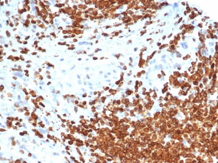 IHC analysis of formalin-fixed, paraffin-embedded human bladder carcinoma. MIS/AMH antibody (AMH/6713R) at 2ug/ml in PBS for 30min RT. HIER: Tris/EDTA, pH9.0, 45min. Secondary: HRP-polymer, 30min. DAB, 5min.