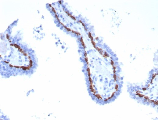 Formalin-fixed, paraffin-embedded human basal cell carcinoma stained with Cytokeratin 15 antibody (KRT15/2958). HIER: Tris/EDTA, pH9.0, 45min. Secondary: HRP-polymer, 30min. DAB, 5min.