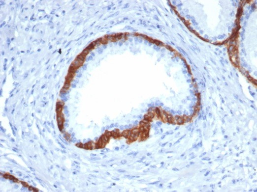 Formalin-fixed, paraffin-embedded human prostate carcinoma stained with Cytokeratin 15 antibody (KRT15/2958). HIER: Tris/EDTA, pH9.0, 45min. Secondary: HRP-polymer, 30min. DAB, 5min.