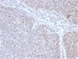 Formalin-fixed, paraffin-embedded human lymphoma stained with DNA Polymerase epsilon subunit 3 antibody (PCRP-POLE3-2F10) at 2ug/ml. HIER: Tris/EDTA, pH9.0, 45min. Secondary: HRP-polymer, 30min. DAB, 5min.