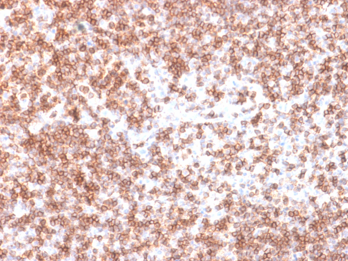 Formalin-fixed, paraffin-embedded Human Lymph Node stained with CD45 antibody (PTPRC/1975R).