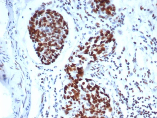 IHC analysis of formalin-fixed, paraffin-embedded human ovarian carcinoma. Strong nuclear staining using WT1 antibody (WT1/3477R) at 2ug/ml in PBS for 30min RT. HIER: Tris/EDTA, pH9.0, 45min. Secondary: HRP-polymer, 30min. DAB, 5min.