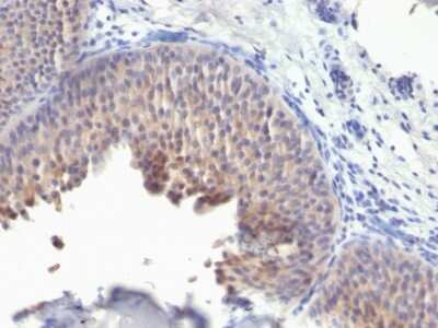 Immunohistochemistry-Paraffin: Cytokeratin 10 Antibody (KRT10/1275) - Azide and BSA Free [NBP3-11417] - Human Bladder Carcinoma stained with Cytokeratin 10 Monoclonal Antibody (KRT10/1275).