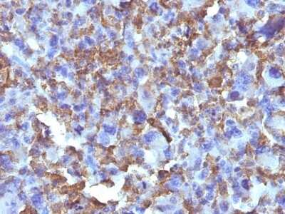 Immunohistochemistry-Paraffin: Macrophage and Histiocytoma Marker Antibody (D11) - Azide and BSA Free [NBP3-11429] - Human Histiocytoma stained with Macrophage Monoclonal Antibody (D11).