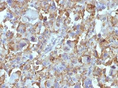 Immunohistochemistry-Paraffin: Macrophage and Histiocytoma Marker Antibody (D11) - Azide and BSA Free [NBP3-11429] - Human Histiocytoma stained with Macrophage Monoclonal Antibody (D11).