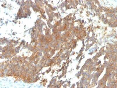 Immunohistochemistry-Paraffin: GnRHR Antibody (GNRHR/768) - Azide and BSA Free [NBP3-11436] - Human Ovarian Carcinoma stained with GnRH-Receptor Monoclonal Antibody (GNRHR/768)