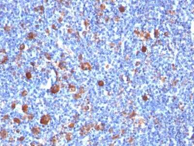 Immunohistochemistry-Paraffin: Fascin Antibody (SPM133) - Azide and BSA Free [NBP3-11444] - Human Hodgkin's Lymphoma stained with Fascin-1 Monoclonal Antibody (SPM133)