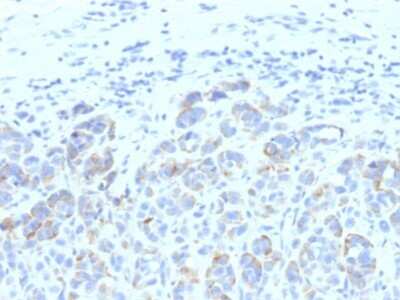 Immunohistochemistry-Paraffin: TYRP1 Antibody (SPM611) - Azide and BSA Free [NBP3-11452] - Human Melanoma stained with TYRP1 Monoclonal Antibody (SPM611)