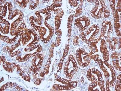 Immunohistochemistry-Paraffin: MUC5AC Antibody (CLH2) - Azide and BSA Free [NBP3-11458] - Formalin-fixed, paraffin-embedded human Gastric Carcinoma stained with MUC5AC Antibody (CLH2). Courtesy of Dr. Leonor David, IPATIMUP and Medical Faculty, University of Porto, Portugal.