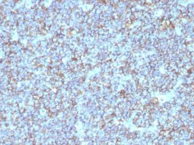Immunohistochemistry-Paraffin: CD99 Antibody (SPM596) - Azide and BSA Free [NBP3-11459] - Human Ewing's Sarcoma stained with CD99 Monoclonal Antibody (SPM596).