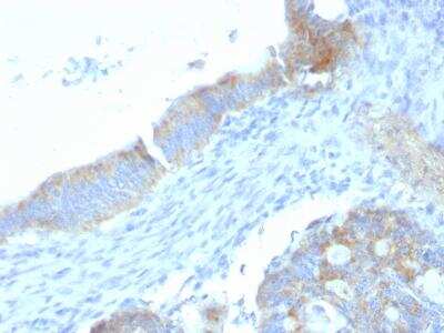 Immunohistochemistry-Paraffin: Endorepellin/Perlecan/Heparan Sulfate Proteoglycan Antibody (SPM255) - Azide and BSA Free [NBP3-11461] - Formalin-fixed, paraffin-embedded human colon carcinoma stained with Heparan Sulfate Monoclonal Antibody (SPM255).