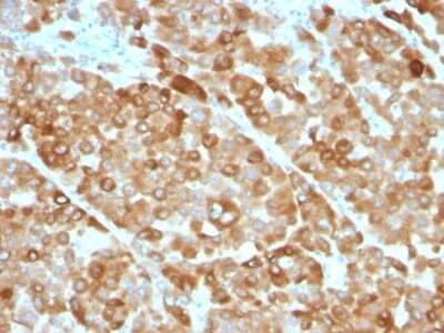 Immunohistochemistry-Paraffin: Tyrosinase Antibody (OCA1/812) - Azide and BSA Free [NBP3-11469] - Melanoma stained with Tyrosinase Monoclonal Antibody (OCA1/812).