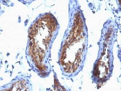 Immunohistochemistry-Paraffin: MVP Antibody (SPM280) - Azide and BSA Free [NBP3-11472] - Human Testicular Carcinoma stained with MVP Monoclonal Antibody (SPM280).