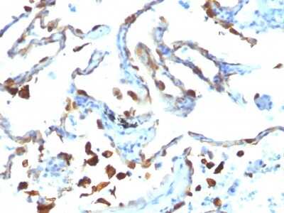 Immunohistochemistry-Paraffin: MFG-E8 Antibody (MFG-06) - Azide and BSA Free [NBP3-11473] - Formalin-fixed, paraffin-embedded human Lung Carcinoma stained with MFG-E8 Antibody (MFG-06)