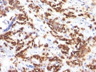 Immunohistochemistry-Paraffin: MFG-E8 Antibody (MFG-06) - Azide and BSA Free [NBP3-11473] - Human Breast Carcinoma stained with Milk Fat Globule Monoclonal Antibody (MFG-06)