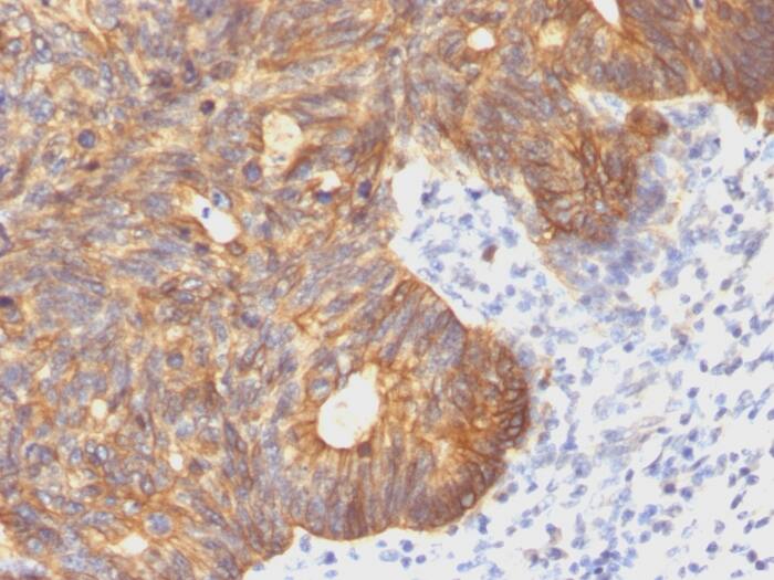 Formalin-fixed, paraffin-embedded human Colon Carcinoma stained with Cytokeratin 8 Antibody (C-43) - Azide and BSA Free.
