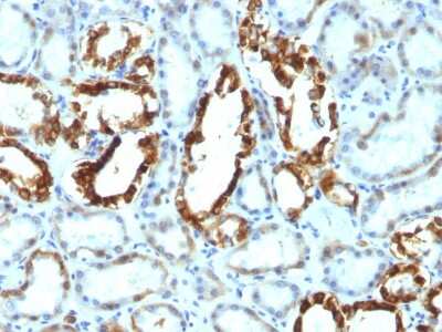 Immunohistochemistry-Paraffin: MFG-E8 Antibody (SPM291) - Azide and BSA Free [NBP3-11482] - Formalin-fixed, paraffin-embedded human Renal Cell Carcinoma stained with MFG-E8 Antibody (SPM291).