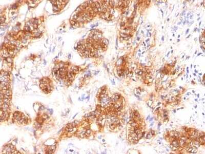 Immunohistochemistry-Paraffin: MFG-E8 Antibody (SPM291) - Azide and BSA Free [NBP3-11482] - Human Breast Carcinoma stained with Milk Fat Globule Monoclonal Antibody (SPM291)