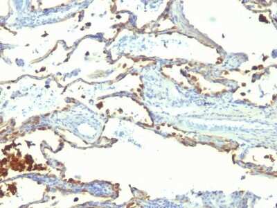 Immunohistochemistry-Paraffin: MFG-E8 Antibody (SPM291) - Azide and BSA Free [NBP3-11482] - Formalin-fixed, paraffin-embedded human Lung Carcinoma stained with MFG-E8 Antibody (SPM291)