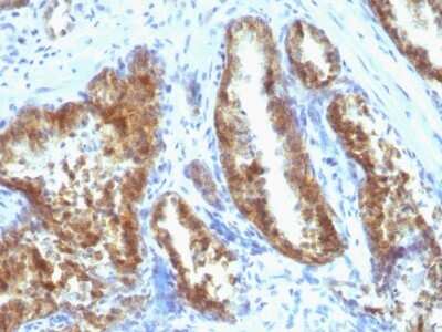 Immunohistochemistry-Paraffin: Kallikrein 3/PSA Antibody (A67-B/E3 + 1A7) - Azide and BSA Free [NBP3-11483] - Human Prostate Carcinoma stained with PSA Monoclonal Antibody (A67-B/E3 + 1A7).