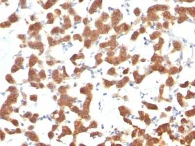 Immunohistochemistry-Paraffin: Cytokeratin 18 Antibody (C-04 (same as Ks18.04)) - Azide and BSA Free [NBP3-11485] - Human Thyroid Carcinoma stained with Cytokeratin 18 Monoclonal Antibody (C-04).