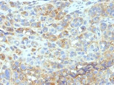 Immunohistochemistry-Paraffin: ICAM-1/CD54 Antibody (W-CAM-1 (same as Wehi-CAM-1 or 1H4)) - Azide and BSA Free [NBP3-11490] - Human Melanoma stained with CD54 Monoclonal Antibody (W-CAM-1).