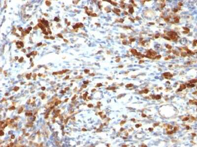 Immunohistochemistry-Paraffin: CD79A Antibody (IGA/764) - Azide and BSA Free [NBP3-11494] - Formalin-fixed, paraffin-embedded human Lymphoma stained with CD79A Antibody (IGA/764)