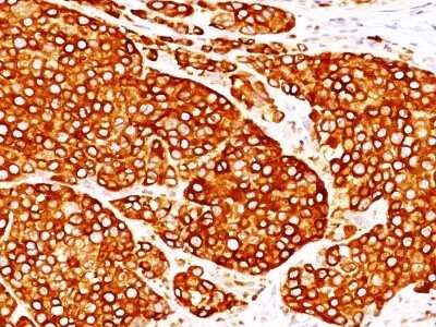 Immunohistochemistry-Paraffin: Tyrosinase Antibody (T311 + OCA1/812) - Azide and BSA Free [NBP3-11499] - Melanoma stained with Tyrosinase Monoclonal Antibody (T311 + OCA1/812).