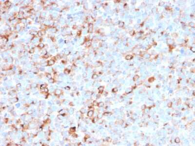 Immunohistochemistry-Paraffin: Tyrosinase Antibody (T311 + OCA1/812) - Azide and BSA Free [NBP3-11499] - Formalin-fixed, paraffin-embedded human melanoma stained with Tyrosinase Mouse Monoclonal Antibody (T311 + OCA1/812).