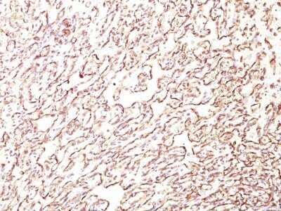 Immunohistochemistry-Paraffin: Podocalyxin Like Antibody (4F10) - Azide and BSA Free [NBP3-11508] - Human Angiosarcoma stained with Podocalyxin Monoclonal Antibody (4F10).