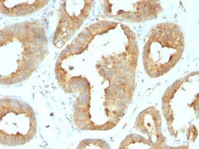 Immunohistochemistry-Paraffin: gp96/HSP90B1/GRP94 Antibody (9G10.F8.2) - Azide and BSA Free [NBP3-11511] - Human Breast Carcinoma stained with GRP94 Monoclonal Antibody (9G10.F8.2).