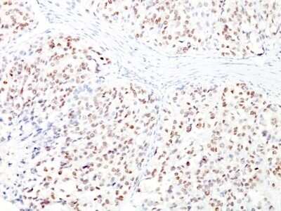 Immunohistochemistry-Paraffin: MITF Antibody (D5 + MITF/915) - Azide and BSA Free [NBP3-11512] - Human Melanoma stained with MITF Monoclonal Antibody (D5 + MITF/915).
