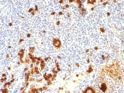 Immunohistochemistry-Paraffin: SSEA-1 Antibody (FUT4/815 + BRA-4F1) - Azide and BSA Free [NBP3-11514] - Human Hodgkin's Lymphoma stained with CD15 Monoclonal Antibody (FUT4/815 + BRA-4F1).