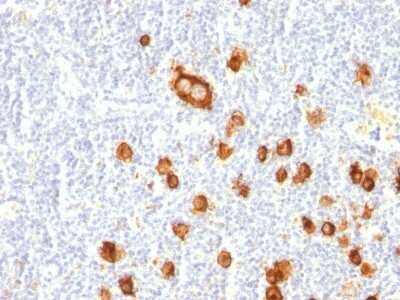 Immunohistochemistry-Paraffin: SSEA-1 Antibody (FUT4/815) - Azide and BSA Free [NBP3-11517] - Human Hodgkin's Lymphoma stained with CD15 Monoclonal Antibody (FUT4/815).