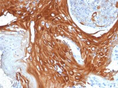 Immunohistochemistry-Paraffin: Cytokeratin 6a Antibody (KRT6A/2368) - Azide and BSA Free [NBP3-11521] - Formalin-fixed, paraffin-embedded human Basal Cell Carcinoma stained with Cytokeratin 6a Antibody (KRT6A/2368).