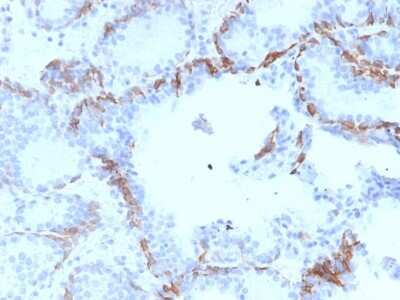 Immunohistochemistry-Paraffin: Cytokeratin 6a Antibody (KRT6A/2368) - Azide and BSA Free [NBP3-11521] - Formalin-fixed, paraffin-embedded human Prostate Carcinoma stained with Cytokeratin 6a Antibody (KRT6A/2368).