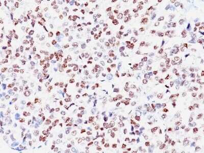 Immunohistochemistry-Paraffin: MITF Antibody (SPM290) - Azide and BSA Free [NBP3-11527] - Human Melanoma stained with MITF Monoclonal Antibody (SPM290).