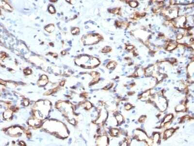 Immunohistochemistry-Paraffin: CD34 Antibody (SPM610) - Azide and BSA Free [NBP3-11532] - Human Angiosarcoma stained with CD34 Monoclonal Antibody (SPM610)