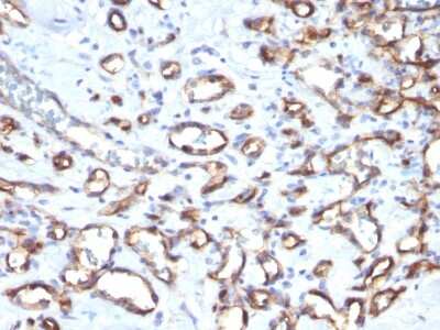 Immunohistochemistry-Paraffin: CD34 Antibody (SPM610) - Azide and BSA Free [NBP3-11532] - Formalin-fixed, paraffin-embedded human Angiosarcoma stained with CD34 Antibody (SPM610)