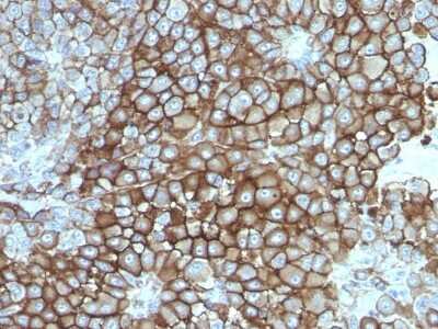 Immunohistochemistry-Paraffin: Melanoma Associated Antigen (KBA.62) Antibody (KBA.62) - Azide and BSA Free [NBP3-11535] - Human Melanoma stained with Melanoma Monoclonal Antibody (KBA.62).